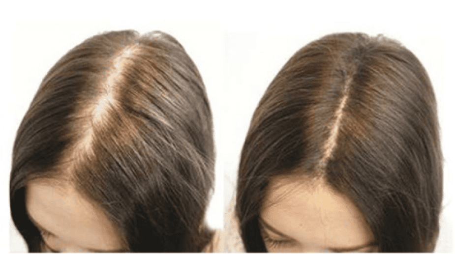 Kích thích mọc tóc